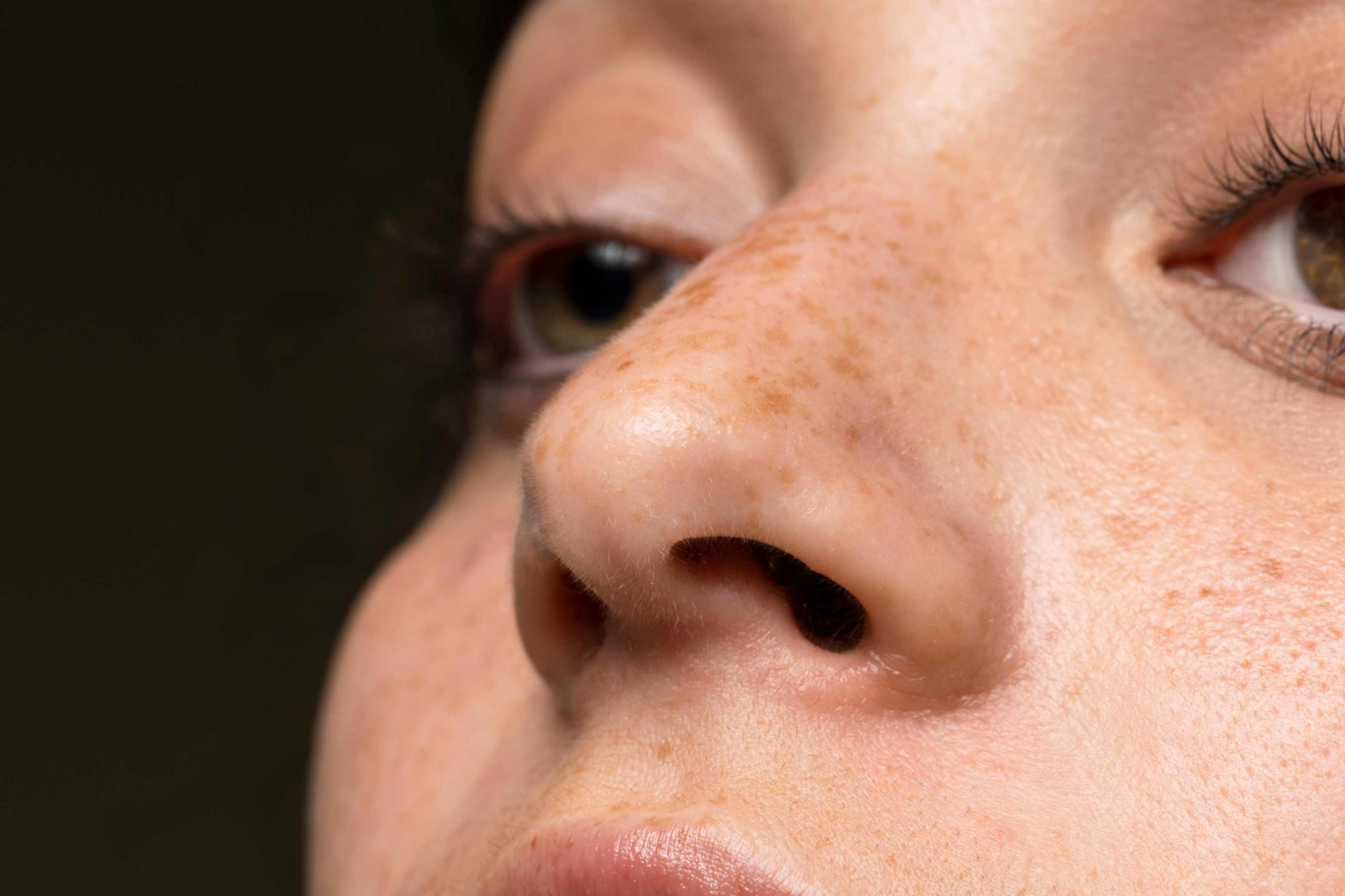 Blackheads: What They Look Like, Treatment And Prevention
