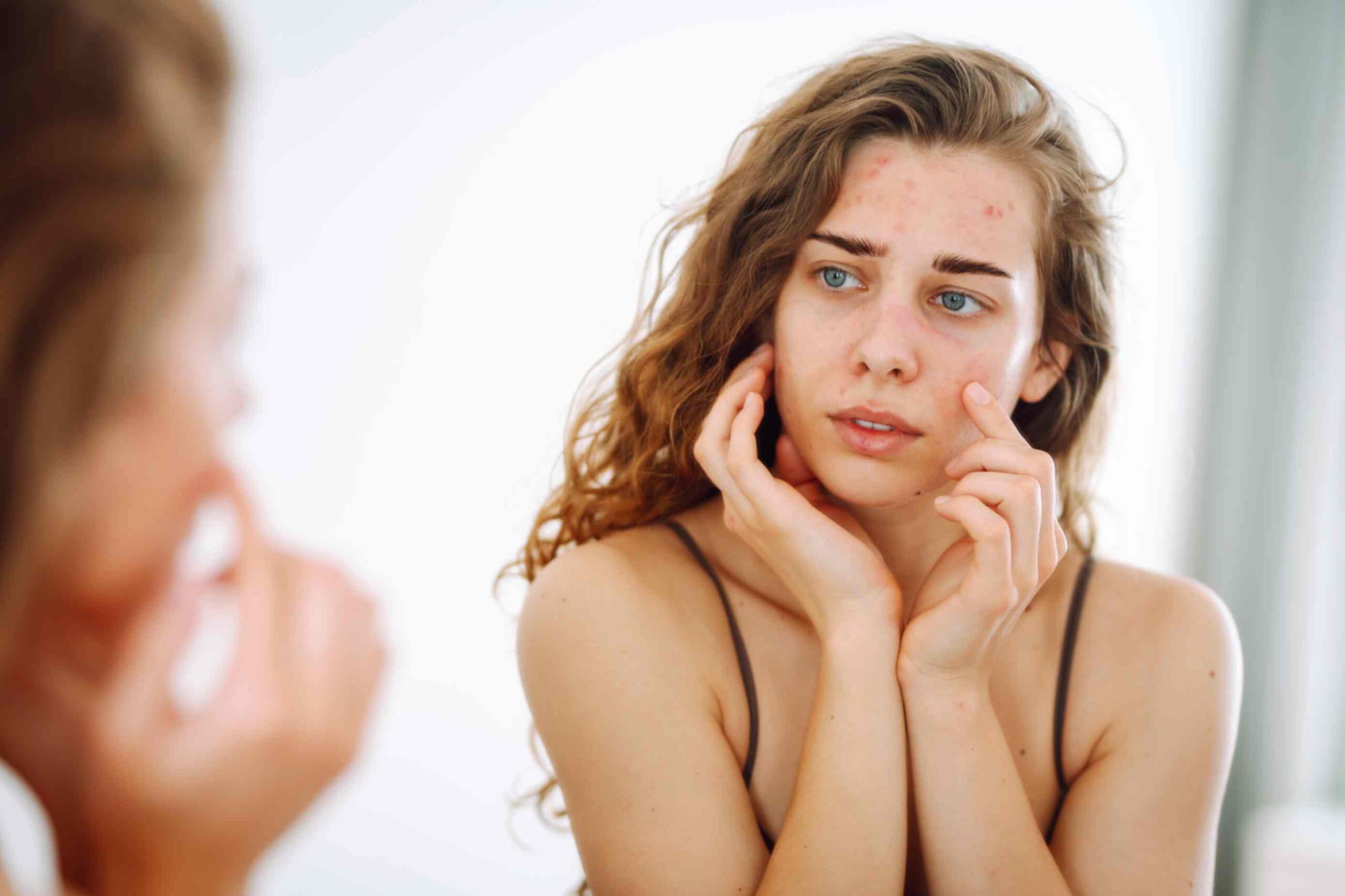 Adult Acne Causes Triggers And How To Treat It Effectively